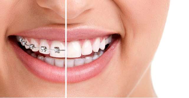 Aparatul dentar – influenta asupra simetriei faciale