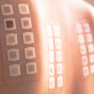 Dermatita de contact și Testarea patch