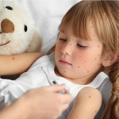 Tot ce trebuie sa stii despre varicela, infectia virala care provoaca febra si eruptie cutanata pe tot corpul