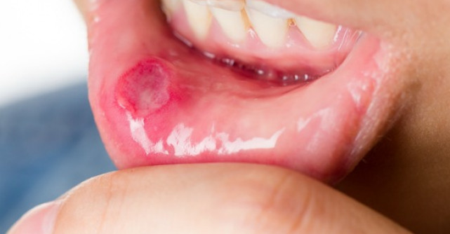 Trateaza stomatita cu produse naturale