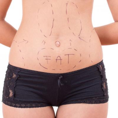 Cum sa scapi grasimea abdominala - abdominoplastia