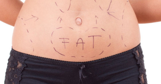 Cum sa scapi grasimea abdominala - abdominoplastia