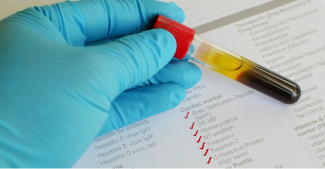 Proteina C reactiva: ce este si ce ne indica valorile sale despre sanatatea organismului