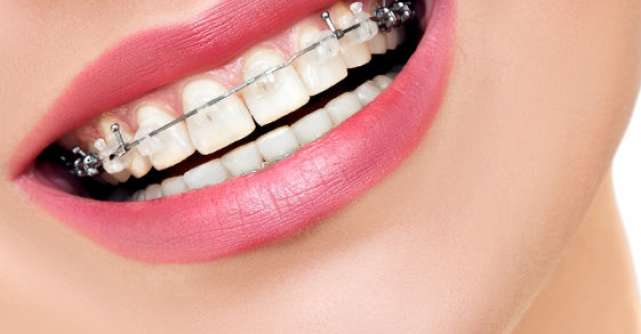 Aparatul dentar: cand si de ce este necesar