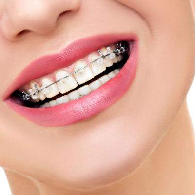 Aparatul dentar: cand si de ce este necesar