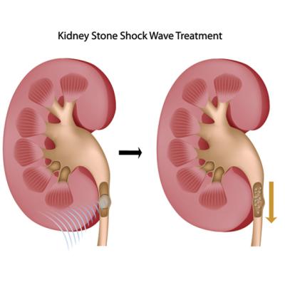 De ce facem PIETRE la RINICHI?