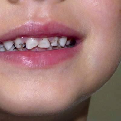 Caria dinților de lapte: de ce apare și ce este de făcut?