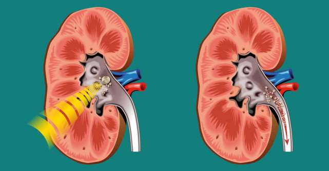 Tratament modern pentru pietrele la rinichi: Litotriția extracorporeală cu unde de șoc ESWL