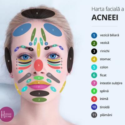 Harta Chinezeasca a ACNEEI: Afla ADEVARATA cauza a cosurilor