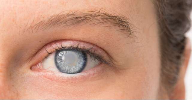 Totul despre cataracta, afectiunea periculoasa care poate duce la pierderea vederii