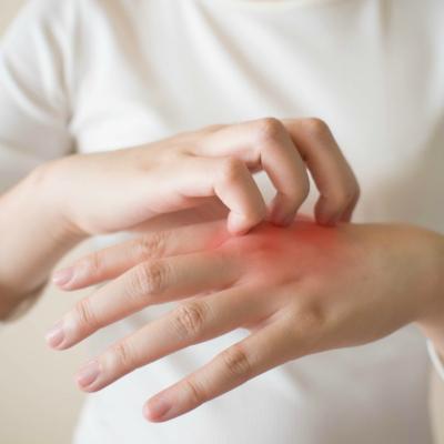 Ce afectiuni poate ascunde o urticarie: cauze, simptome, diagnostic si tratament