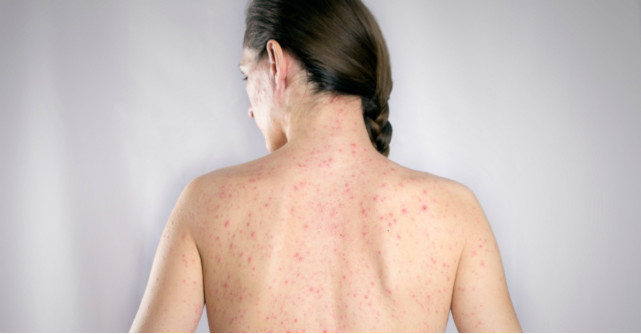 Rubeola – cine este in pericol si cum influenteaza femeile gravide: simptome, cauze si tratament