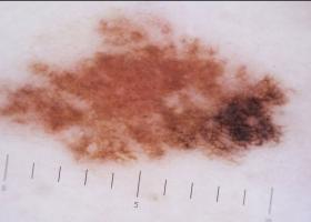 Formula ABCDE pentru a depista alunițele cancerigene