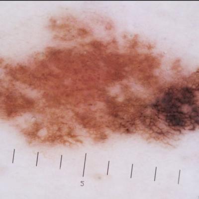 Formula ABCDE pentru a depista alunițele periculoase