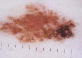 Formula ABCDE pentru a depista alunițele cancerigene