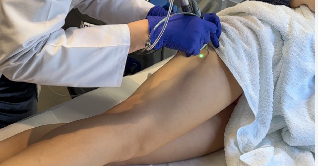 Tratamentul cu Laser Vascular pentru Telangiectazii la Illuma Clinique