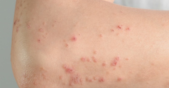 Zona Zoster - o boala contagioasa si suparatoare
