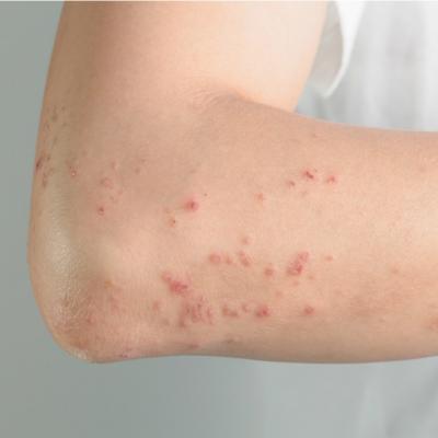 Zona Zoster - o boala contagioasa si suparatoare