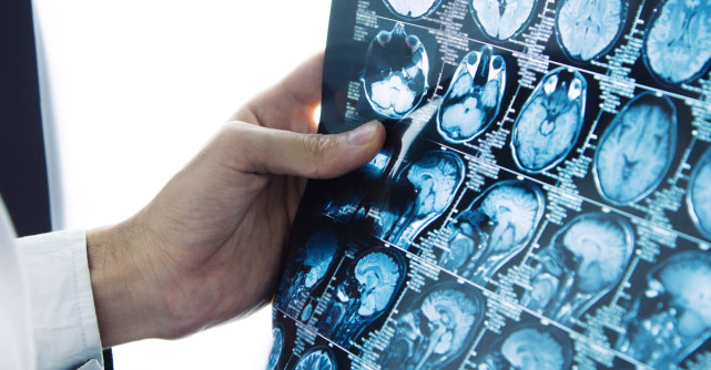 Avantajele intervențiilor de neuroradiologie intervențională: tratamente minim invazive pentru afecțiuni cerebrale și spinale 