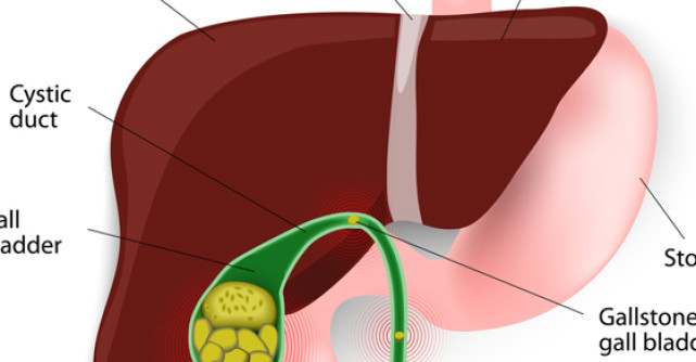 Scapa de pietre la ficat si fiere