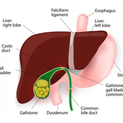 Scapa de pietre la ficat si fiere
