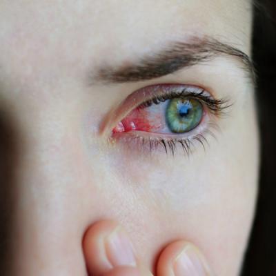 Conjunctivita: care sunt cele mai frecventa cauze si cum sa te feresti