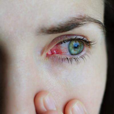 Conjunctivita: care sunt cele mai frecventa cauze si cum sa te feresti