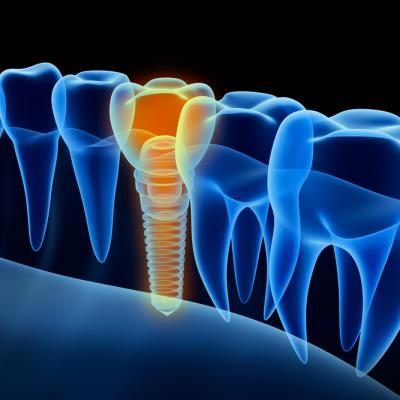 Ce contraindicații există în cazul tratamentului cu implant dentar?