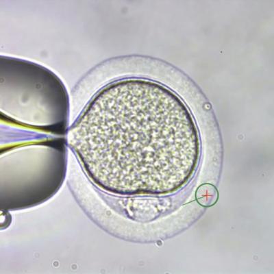 Poti evita transmiterea unor boli ereditare prin diagnosticul genetic preimplantational