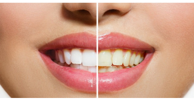 Amestecul minune care iti albeste dintii. Iata cat de usor se poate prepara acasa