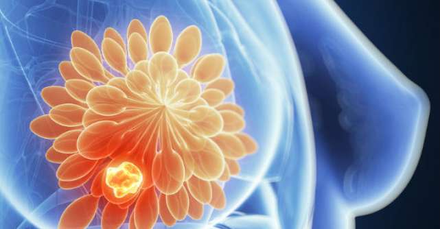5 conceptii gresite despre cancerul mamar
