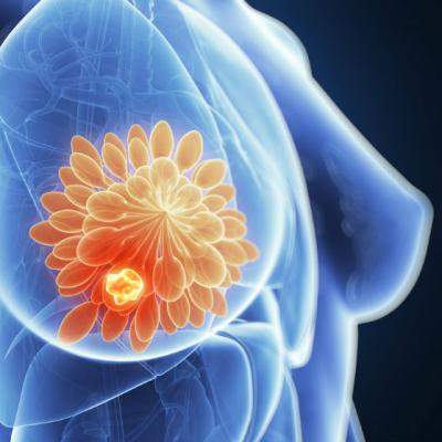 5 conceptii gresite despre cancerul mamar