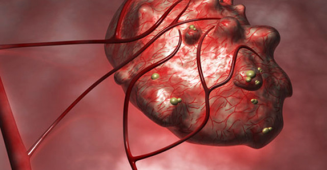 Chisturile ovariene duc la infertilitate? Dar chisturile endometriozice?