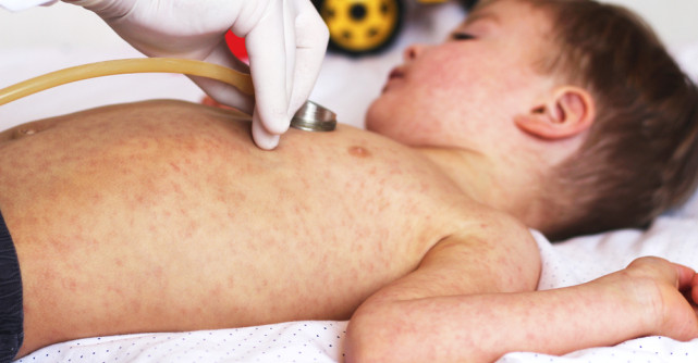 Totul despre pojar sau rujeolă