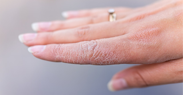 Dishidroza,un rezultat al stresului