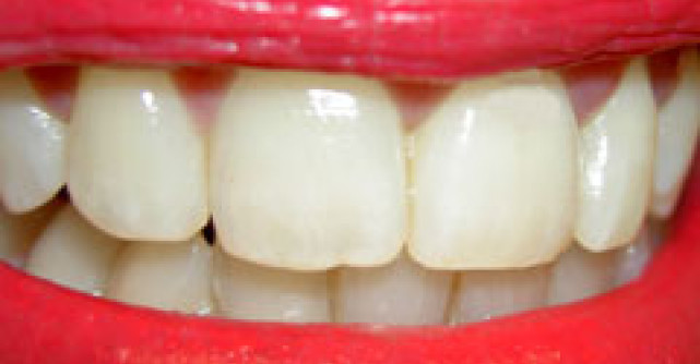 Doar 50% dintre oraseni au o igiena orala adecvata