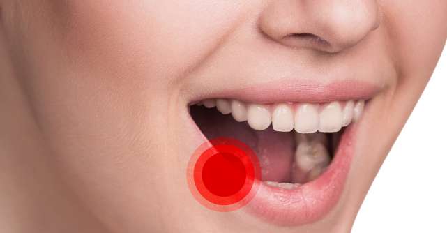 8 Cauze și factori de risc care determină apariția aftelor bucale