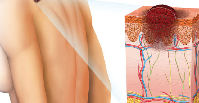 Zilele Melanomului - ce ar trebui sa stii despre cancerul de piele