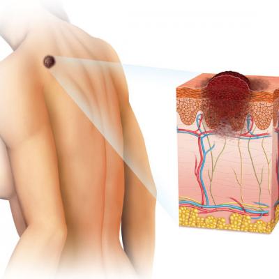 Zilele Melanomului - ce ar trebui sa stii despre cancerul de piele