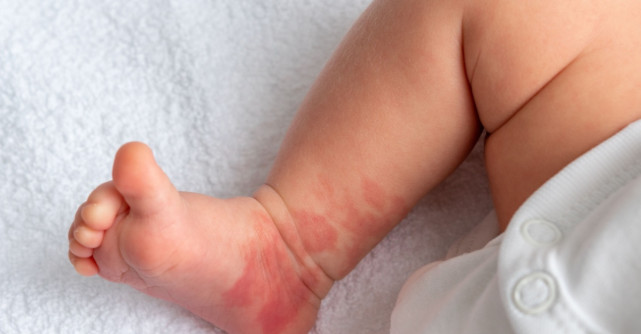 Pete roșii la nou-născuți: când să te îngrijorezi? 