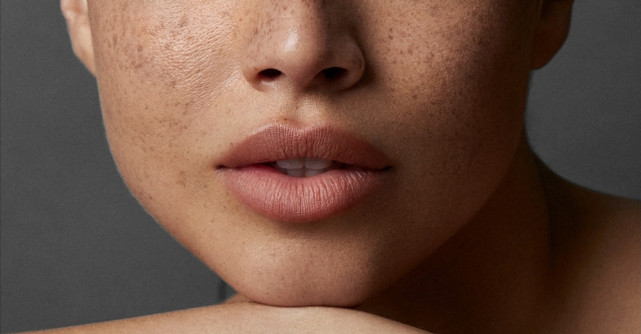 Pistruii falși – artificiul estival care îți aduce farmecul inocent al verii pe chip