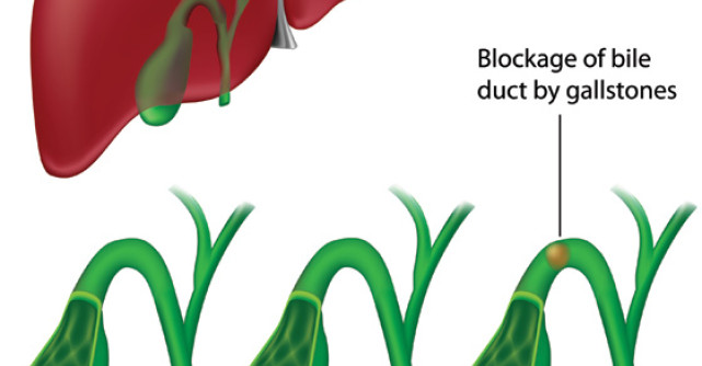 Pietrele la fiere sau LITIAZA BILIARA: despre riscuri, simptome si tratament