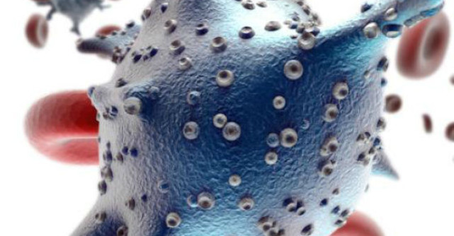 Limfomul Hodgkin sau Boala Hodgkin