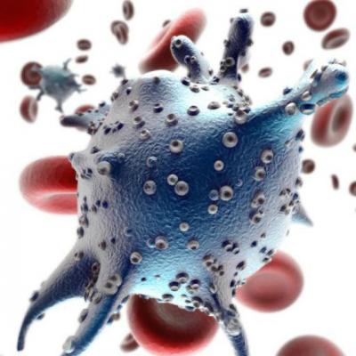 Limfomul Hodgkin sau Boala Hodgkin