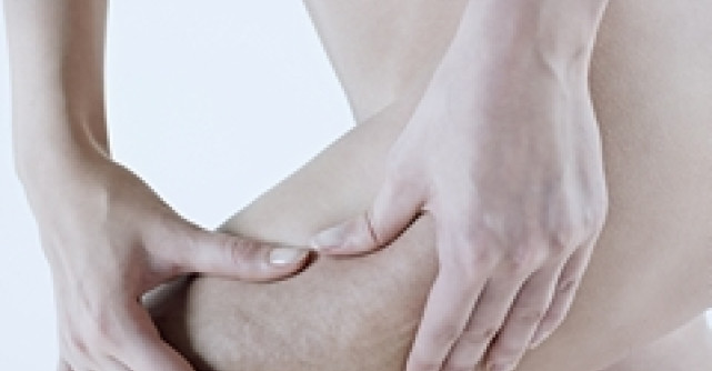 Dermoingrijirea anticelulitica