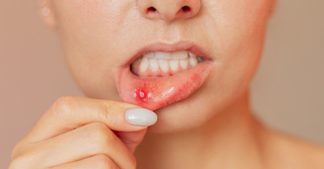 Leacuri bătrânești pentru afte - remedii naturale eficiente