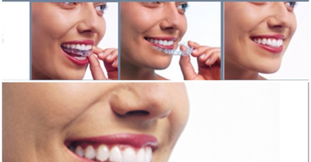 Invisalign - alternativa invizibila a aparatului dentar in Clinica Dr. Melnic