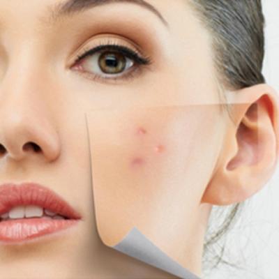 Acneea iti da batai de cap? Exista un tratament complex care te poate vindeca