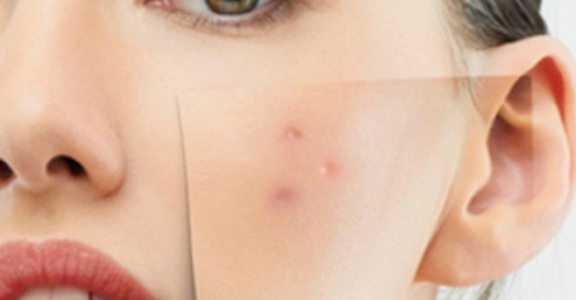 Acneea iti da batai de cap? Exista un tratament complex care te poate vindeca