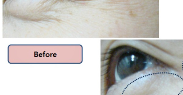 VIVACE - alegere simpla si inteligenta pentru efect anti-aging  garantat, fara durere si fata timp de recuperare